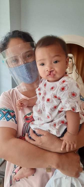 Operation Smile Cleft Palate and Lip Surgery